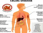 Celiac disease symptoms