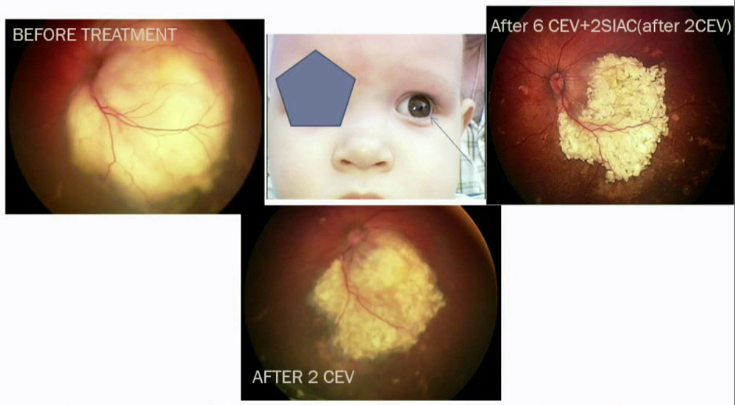 Intravitreal Chemotherapy for retinoblastoma and eye cancer